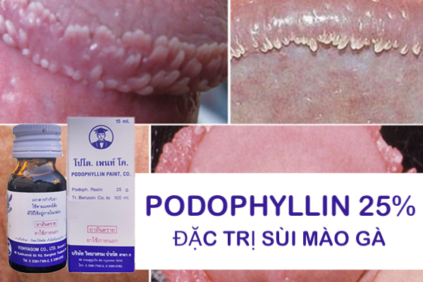  Mua Thuốc Podophyllin 25 Thái Lan chữa trị sùi mào gà tại nhà cho nam nữ hàng xách tay